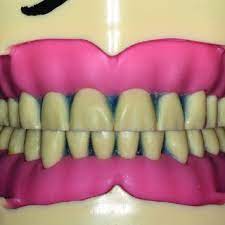 Recessed lighting installation necrotizing myositis fdgard. Pdf Digital Workflow To Rehabilitate Worn Dentition On A Non Hinge Simulated Patient