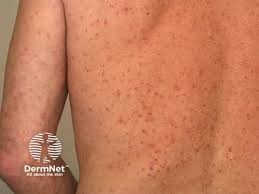 Image result for scabies on humans