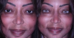 Vision Correction Los Angeles