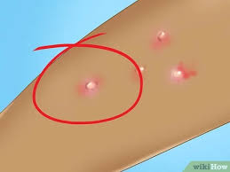 Compare a giant zit or blister to a razor bump, and it's easy to spot the difference. How To Recognize Molluscum Molluscum Contagiosum 11 Steps