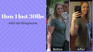 How I Lost 30 Pounds Fast With The Nexplanon Youtube