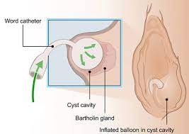 Word Catheter For Bartholin's Abscess — Chelsea And Westminster Hospital  Nhs Foundation Trust
