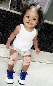 Alopecia areata is a skin disorder that causes hair loss, usually in patches, most often on the scalp. Little Girl Born With A White Patch Of Hair Which Is Exactly The Same As Her Mum S Bored Panda