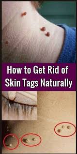 How To Get Rid Of Skin Tags Naturally Healthy Life Style Skin Tag Home Remedies For Skin Juice For Skin