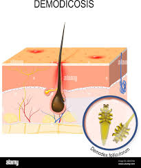 Image result for Demodex folliculorum