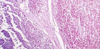It can be an acute, subacute. True Myocarditis Uncommon In Covid 19 Review Concludes Tctmd Com