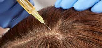 فوائد حقن الميزوثيرابي للشعر حياتك