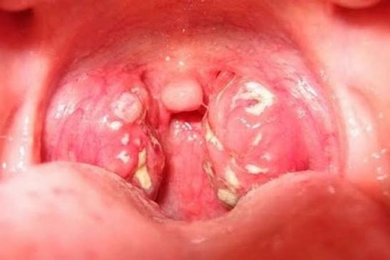 Mách bạn: Nổi cục trắng, mùi hôi trong họng là bệnh gì
