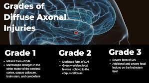 Diffuse Axonal Brain Injuries Baltimore Maryland Car Accident Lawyers