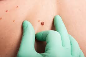Lungs and area between the lungs: Non Melanoma Skin Cancer Web Hub Ecpc European Cancer Patient Coalition