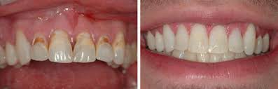 Use this page to learn how to convert between molar and millimolar. Teeth Sealants Dental Treatment Services Dua Dental Care Zirakpur Id 7471656130