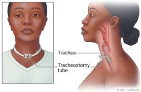 Image result for Tracheostomy