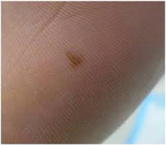 In stage 3, melanoma spreads to your lymph nodes or to another spot either. Melanoma Of The Feet Misdiagnosed And Misunderstood Sciencedirect