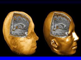 Early intervention and prevention for psychotic disorders in Transitional  Age Youth Cameron S Carter MD.