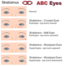 Strabismus Surgery Abc Eyes Strabismus Surgery Lazy Eye Exercises Optician Training
