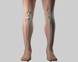 Un succès d'équipe!» conférence, dr jacques vallotton, avec julien rappaz et david conte. Prothese Totale De Genou Docteur Matthieu Meyer