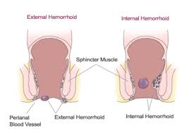 Image result for Hemorrhoid