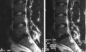 Serial Mr Imaging Of Annular Tears In Lumbar Intervertebral Disks American Journal Of Neuroradiology