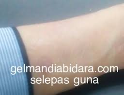 Penyakit sopak garam ini berlaku akibat daripada tindak balas badan pesakit kepada sesetengah faktor, sama ada yang berasal daripada dalam atau sentiasa cakna waktu dan tempat berlaku urtikaria serta aktiviti harian. Rahsia Penawar Gatal Gatal Kulit Bidara Specialist