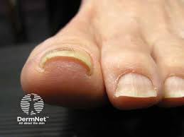 Image result for Pitting nails feet