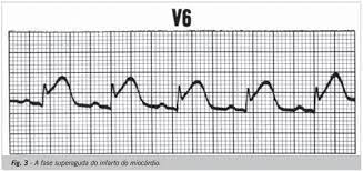Ecg no enfarte do miocárdio. Scielo Brasil Analise De Registros Eletrocardiograficos Associados Ao Infarto Agudo Do Miocardio Analise De Registros Eletrocardiograficos Associados Ao Infarto Agudo Do Miocardio
