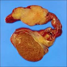 mesothelioma is a malignant tumor that arises from the mesothelial surfaces of the pleural and peritoneal cavities, the tunica vaginalis, or the pericardium. On Gross Examination The Left Orchiectomy Specimen Was Composed Of A Download Scientific Diagram