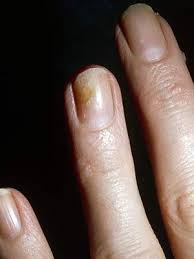 Check spelling or type a new query. What Are The White Spots On Your Nails Trying To Tell You Everyday Health