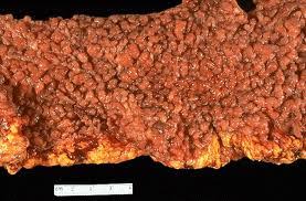 Image result for Gardner Sendromu