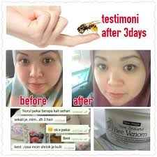 First night of using bee venom toner and bee venom emulsion will upload a new video after 1 week to see the results. Cantikdenganbeevenom Ingin Kulit Yang Cantik Bebas Jerawat Bebas Kerutan Bebas Jeragat Awet Muda Glowing Serta Radiant Flawless Natural Beauty