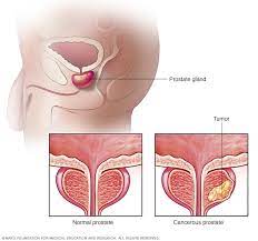 Prostate cancer signs and symptoms: Prostate Cancer Symptoms And Causes Mayo Clinic