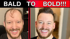 Hair Restoration