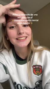 Resultados del blanqueamiento dental ambulatorio