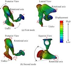 Image result for Ossicular Chain Disruption