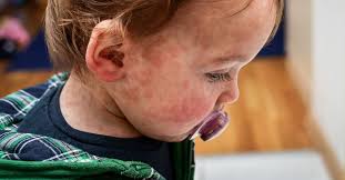 Image result for Allergic Colitis of Infancy