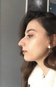 Best Decision I Have Ever Made. From a Hooked Nose to a...