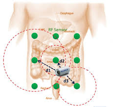 Image result for Wireless Capsule Endoscopy