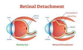 We did not find results for: Retinal Detachment Causes How To Get Treatment Nvision Eye Centers