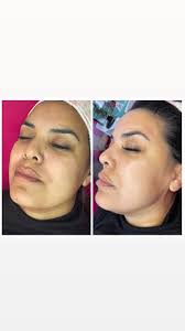 #estetica #belleza #peeling #peelingfacial #facial