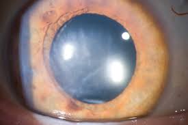 Image result for Cataract Extraction