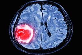 La trombosis cerebral es la pérdida de oxígeno de una región del cerebro como consecuencia de la la trombosis cerebral tiene un tratamiento específico y este puede hacerse en las primeras 4. Trombosis Cerebral Que Es Sintomas Secuelas Y Tratamiento Tua Saude