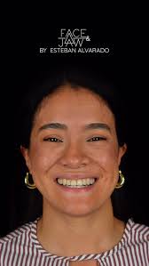 Cirugía Ortognática, ¡la especialidad de la casa! ⚡️👊🏻,  @clinica.smartdental , @jackii_ms , #jawsurgery , #doublejawsurgery ,  #doublejawsurgeryrecovery , #maxilofacial , #Costarica ...