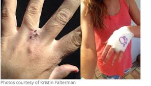 Sep 11, 2017 · mix a few tablespoons of it with water in a small container until you have a thick paste that you can spread on your skin. Hair Splinters Show Dog Store