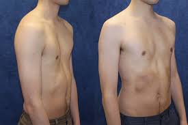Pectus excavatum (pe) is a deformity of the chest wall characterized by sternal depression, which typically begins over the pectus excavatum: Pectus Excavatum Case Histories