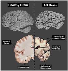 Brain Atrophy What Is Normal Dementia Sos