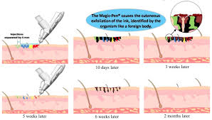 How does laser tattoo removal work? Tattoo Removal Device Magic Pen Erasing Tattoos Without Scars Tepr Method