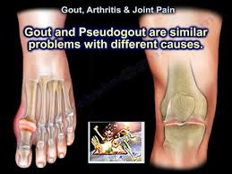 Image result for gout symptoms knee