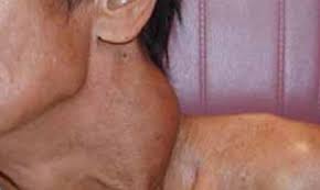 Here are some warning signs to look for to tell if a lump may be cancerous: Neck Lumps Luke Tan Ent Head Neck And Thyroid Surgery
