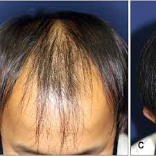 50% of male cases are affected by this hair loss at least once in their life. A Clinical Photo Of 17 Year Old Male With Diffuse Hair Loss Bulbous Download Scientific Diagram