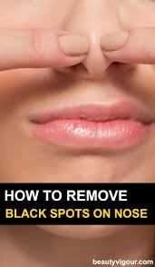How To Remove Black Spots On Nose Fast Beautytips In 2020 Deep Blackheads Skin How To Remove