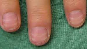 Image result for Beau lines feet